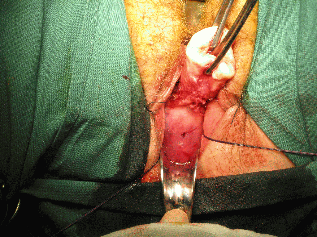 vaginal hysterectomy surgery1